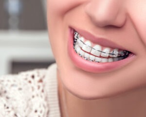 Clear Braces