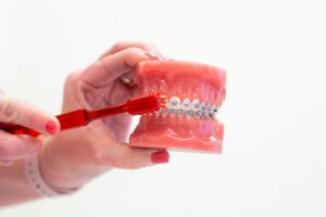 Braces Allen