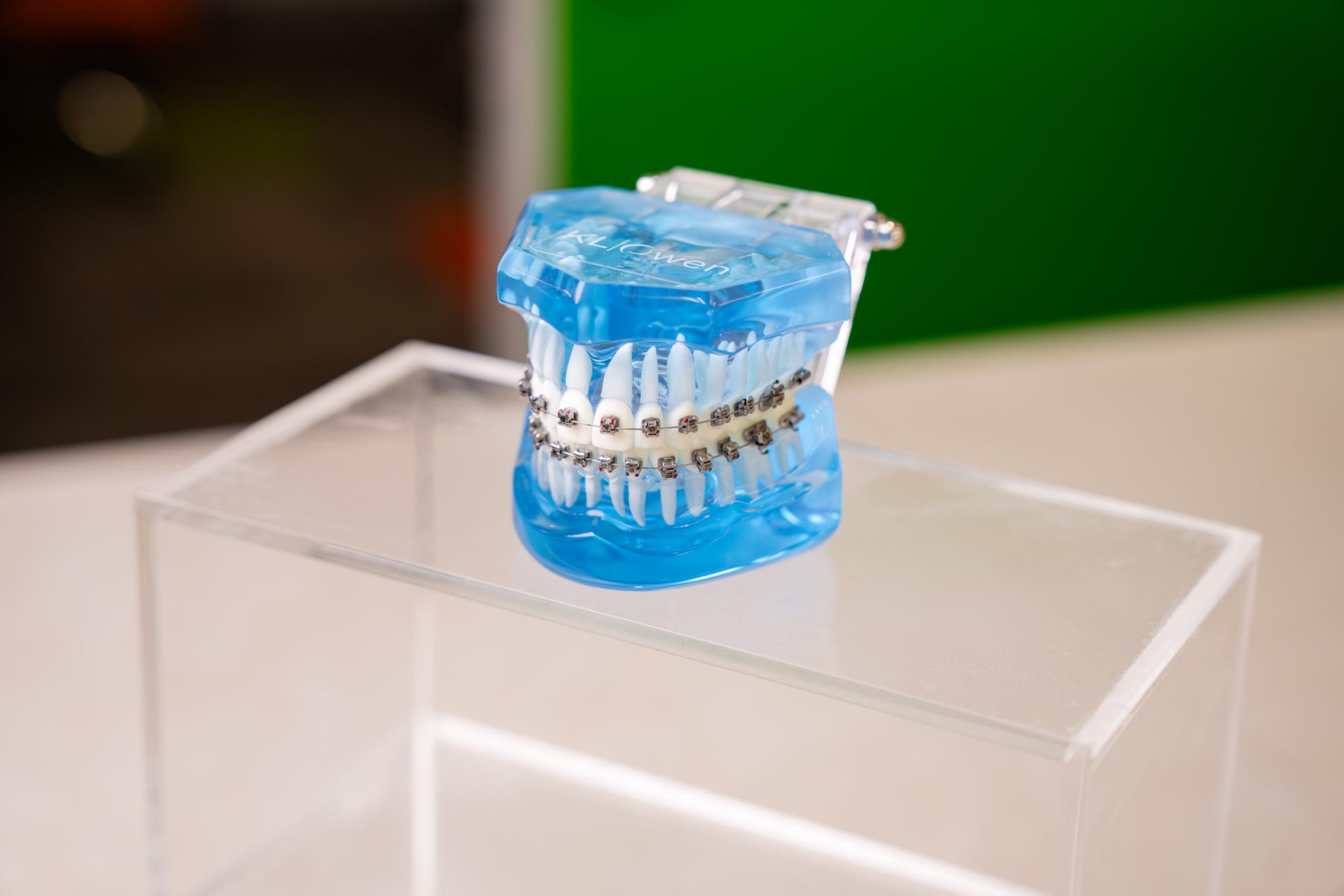 Model of KLOwen braces on a clear display, showcasing metal brackets and white teeth, emphasizing advanced orthodontic technology for effective teeth alignment.