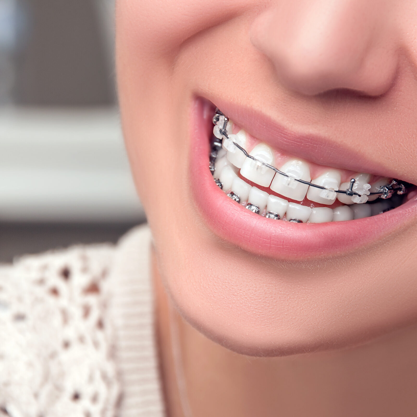 Clear Braces